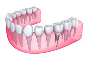sacramento-mini-dental-implants