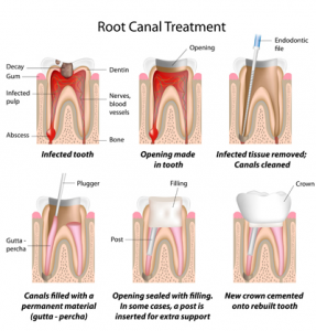 sacramento-root-canal-treatment