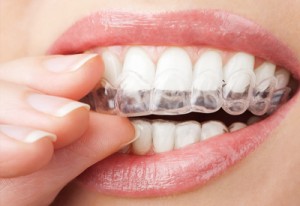 sacramento-teeth-whitening